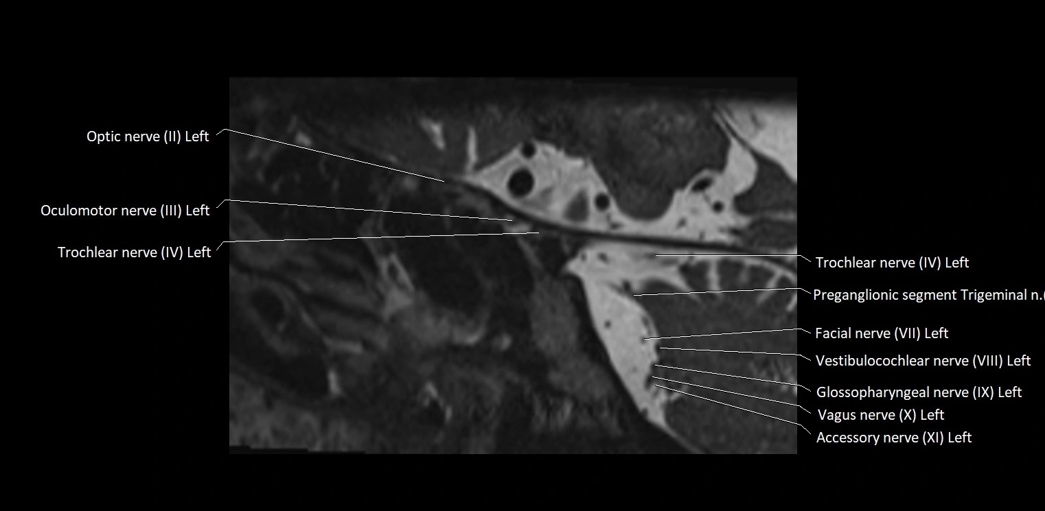 Cranial nerve sagittal anatomy MRI 3T image 22.webp